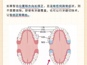 智齿是否有必要拔除需要根据具体情况判断