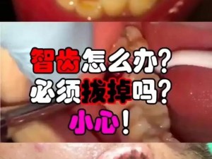 成人拔智齿有危险吗？专业口腔医院，舒适无痛，快速解决智齿问题