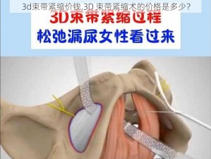 3d束带紧缩价钱,3D 束带紧缩术的价格是多少？