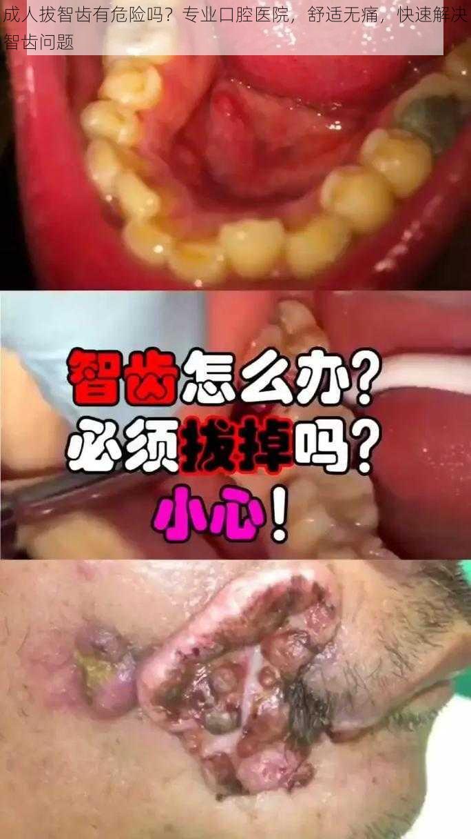 成人拔智齿有危险吗？专业口腔医院，舒适无痛，快速解决智齿问题